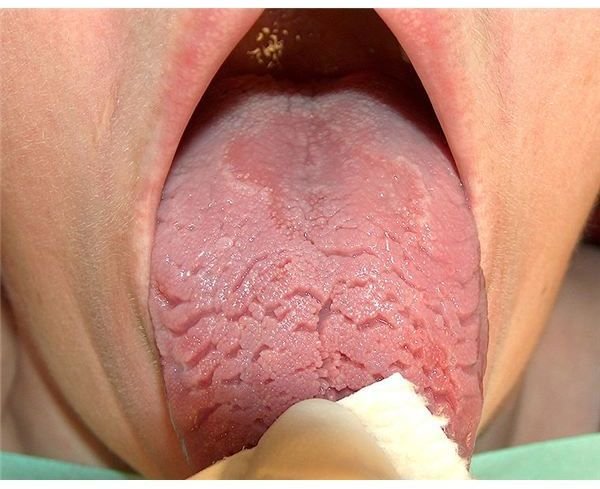 Tongues With Cracks