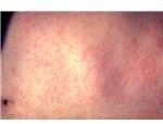 By day three, the measles rash has spread to the trunk