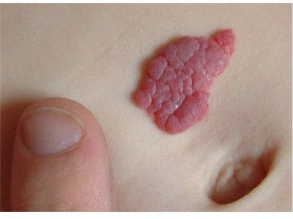 Birthmark | Mole | Hemangioma | Mongolian Spot | MedlinePlus