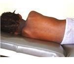 The rash is more difficult to see on darker skin