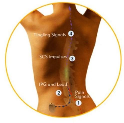 Spinal Cord Stimulator Trial Problems After Cataract