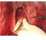 Facetectomy