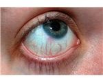 Irritated Eye