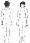 Fibromyalgia Tender Points. NIH. Public Domain.