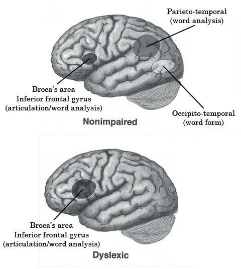 neurologically speaking: dyslexia and the brain"s