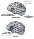 A Nonimpaired Brain Compared to One with Dyslexia