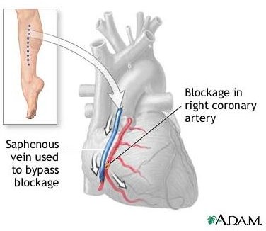 Info On Quadruple Bypass Surgery Survival Rate