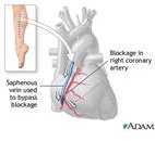Coronary Artery Bypass