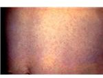 The rubella rash is very similar to the regular measles rash. It is less intense and not as red.
