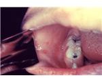 Kaplik's spots in the mouth of a patient with measles