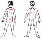 18 Pressure Points to Diagnose Fibromyalgia from Wikipedia Commons
