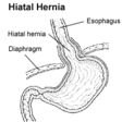 hiatal hernia