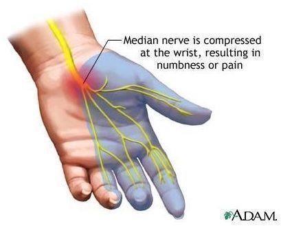 Find Natural Remedies for Carpal Tunnel Syndrome