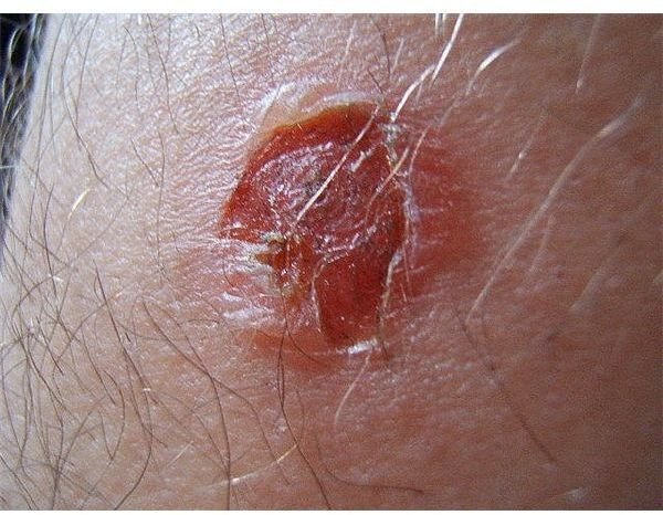 Causes and Natural Treatment of Impetigo in Elderly Adults