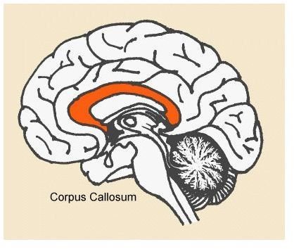 Agenesis of the Corpus Callosum (ACC)