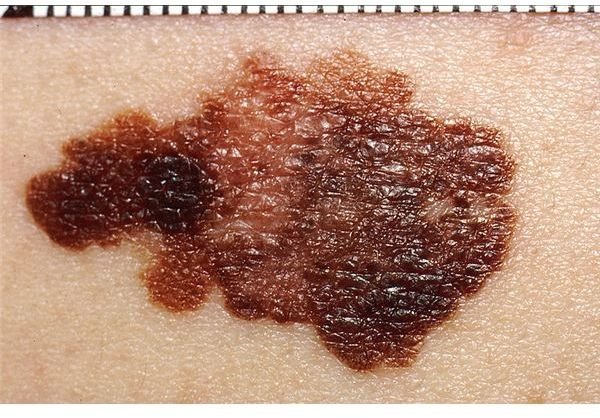 How Fast Does Melanoma Spread and What Should I Know About this Skin Cancer?