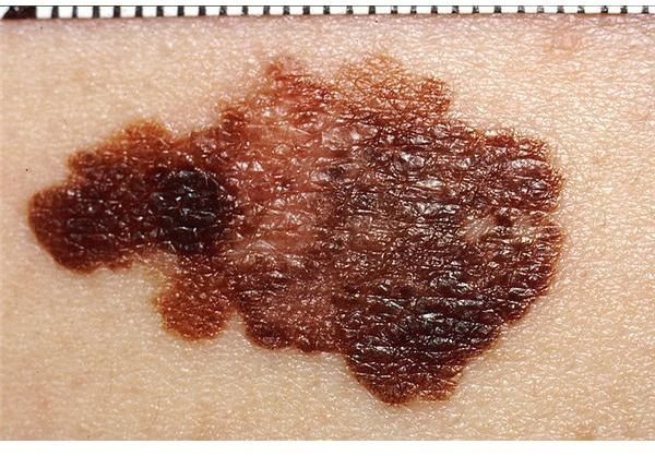 how-fast-does-melanoma-spread-and-what-should-i-know-about-this-skin