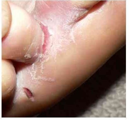 Is Athlete's Foot Contagious?  Athlete's Feet and the Spread of Symptoms