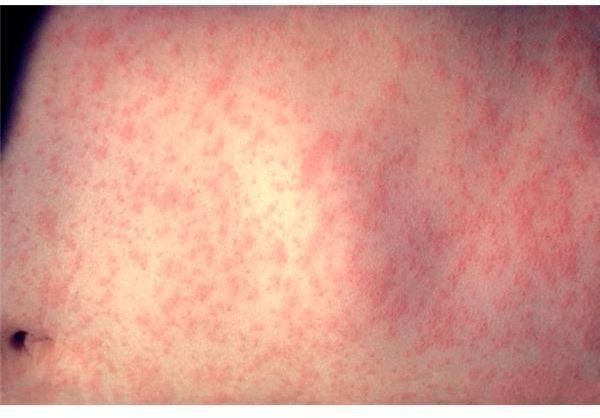 By day three, the measles rash has spread to the trunk