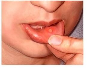 Canker Sores: Natural Remedies to Promote Healing