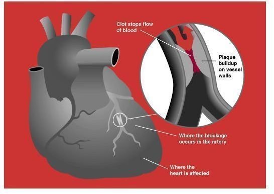 An Overview of Diabetes Heart Attack Signs and Symptoms ...