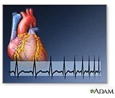 Life After a Heart Attack and Heart Attack Prevention