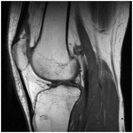 MRI of Knee