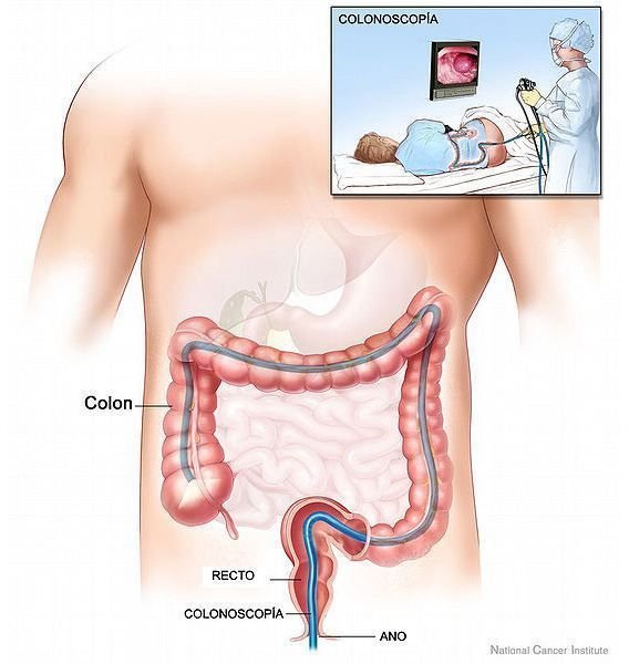 Colonoscopia