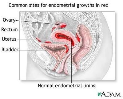 Learn About Chinese Herbs for Endometriosis