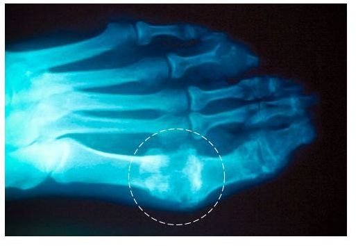 Let's Explore the Symptoms of Gout and its Treatment