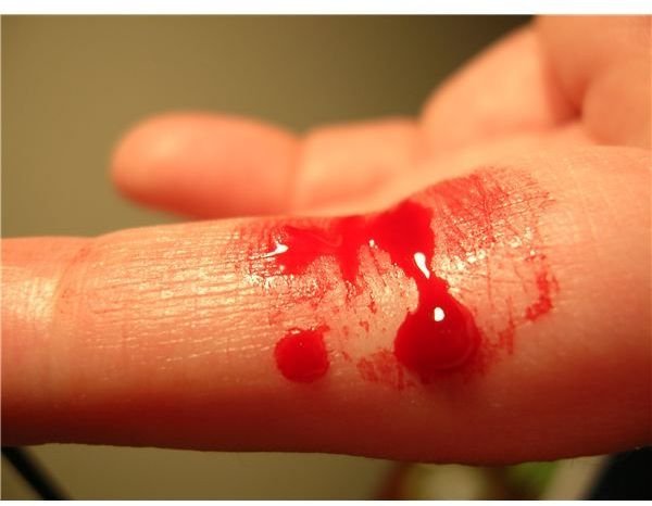 Bleeding finger