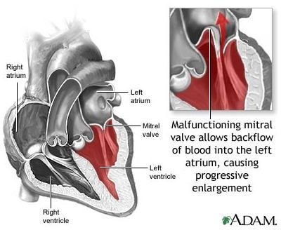 Learn about Mitral Valve Prolapse Treatment