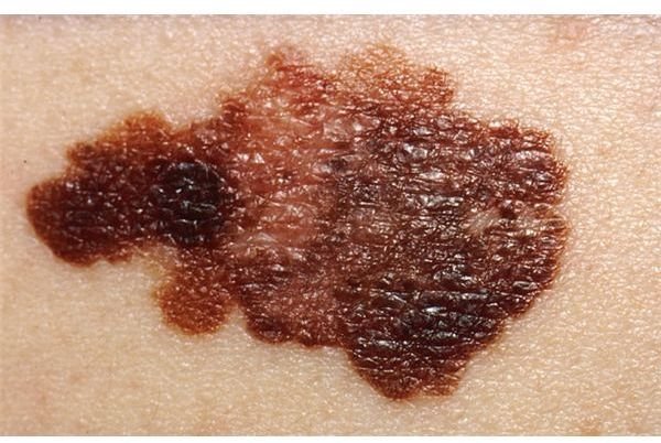 Uncovering the Cause of Malignant Melanoma in the Search for New Malignant Melanoma Treatments