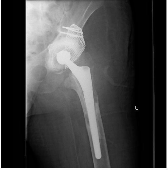Hip Joint Replacement and Rehabilitation