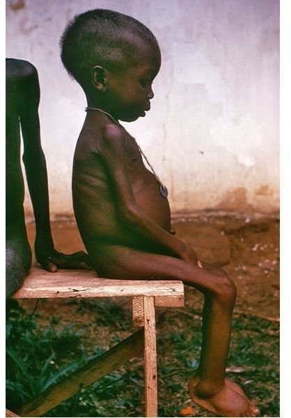 the-effects-of-starvation-facts-on-how-inadequate-nutrition-affects