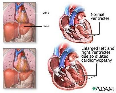 Learn about Alcoholic Cardiomyopathy