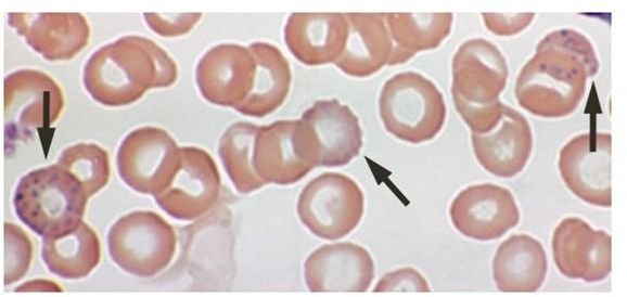 Lead poisoning - blood film