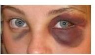 How to Heal a Black Eye with Natural Remedies