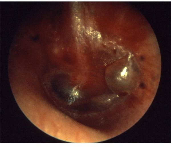 Diagnosis and Treatment of Otitis Media (Middle Ear Infection)