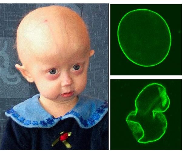 What is Progeria?  A Look at the Genetics of Progeria Disease