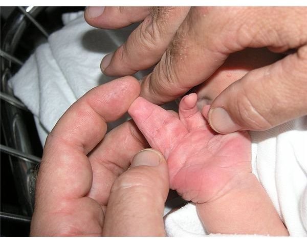 Syndactyly FAQ:  How is Syndactyly Inherited and What are the Causes of Syndactyly?