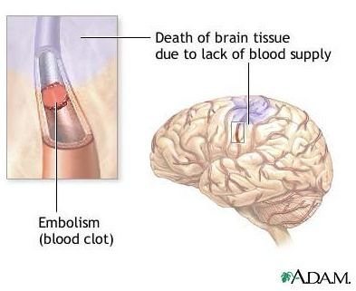 Foods that Prevent Stroke