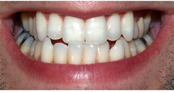 How to Make White Teeth - Genetics Could Help Turn Yellow Teeth White