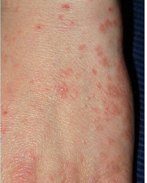 An Answer to the Medical Question: What Does Scabies Look Like?