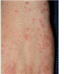 An Answer to the Medical Question: What Does Scabies Look Like?