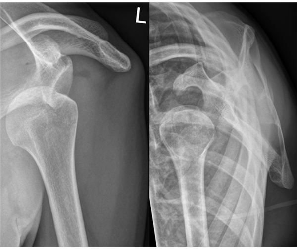 wikimedia commons, dislocated shoulder, Hellerhof