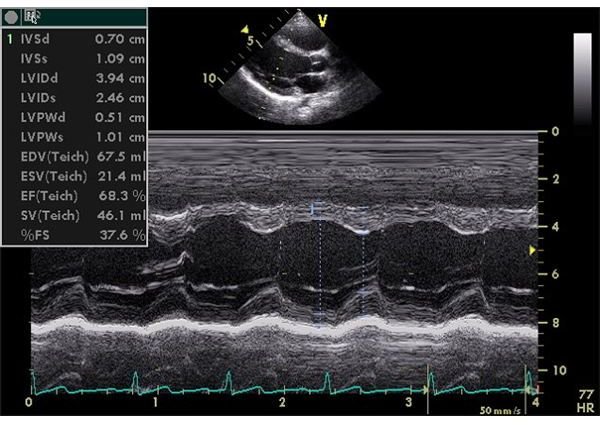 New Computer Science Tool Detects Heart Disease