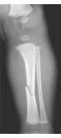 Twenty-Two Types of Bone Fractures