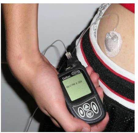 An Insulin Pump Comparison Guide