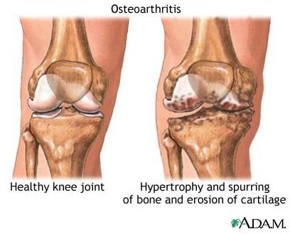 Osteoarthritis - Image courtesy of the National Library of Medicine (NLM)